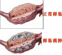 <b>卵巢囊肿患者的常见表现有哪些</b>
