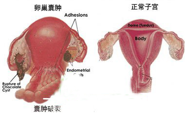 <b>恶性卵巢囊肿的主要症状</b>