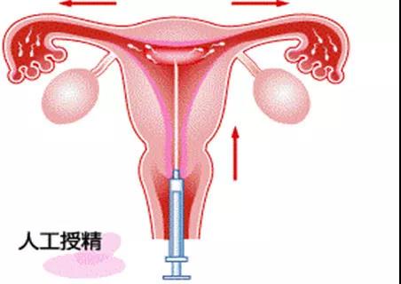 输卵管性疾病？这几种方法助你成功怀孕！